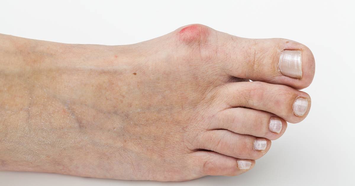 Bunions in Foot