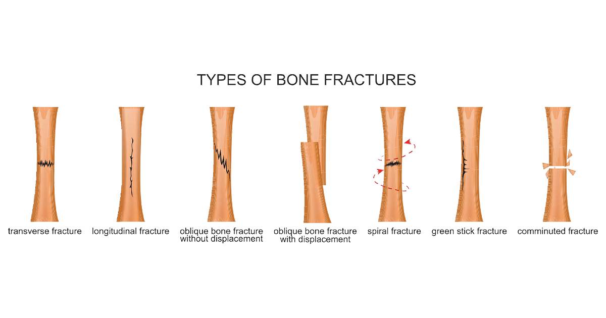 Bone Fractures
