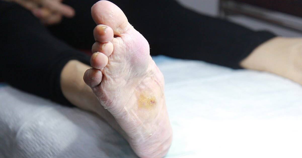 Charcot Foot