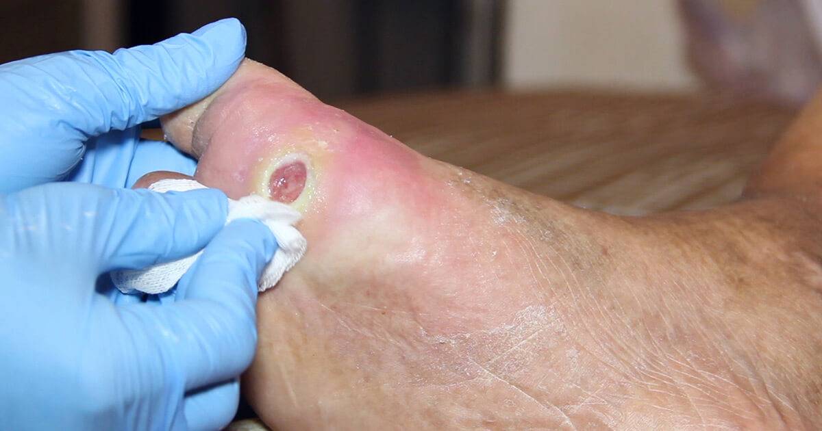 Diabetic Foot Ulcer