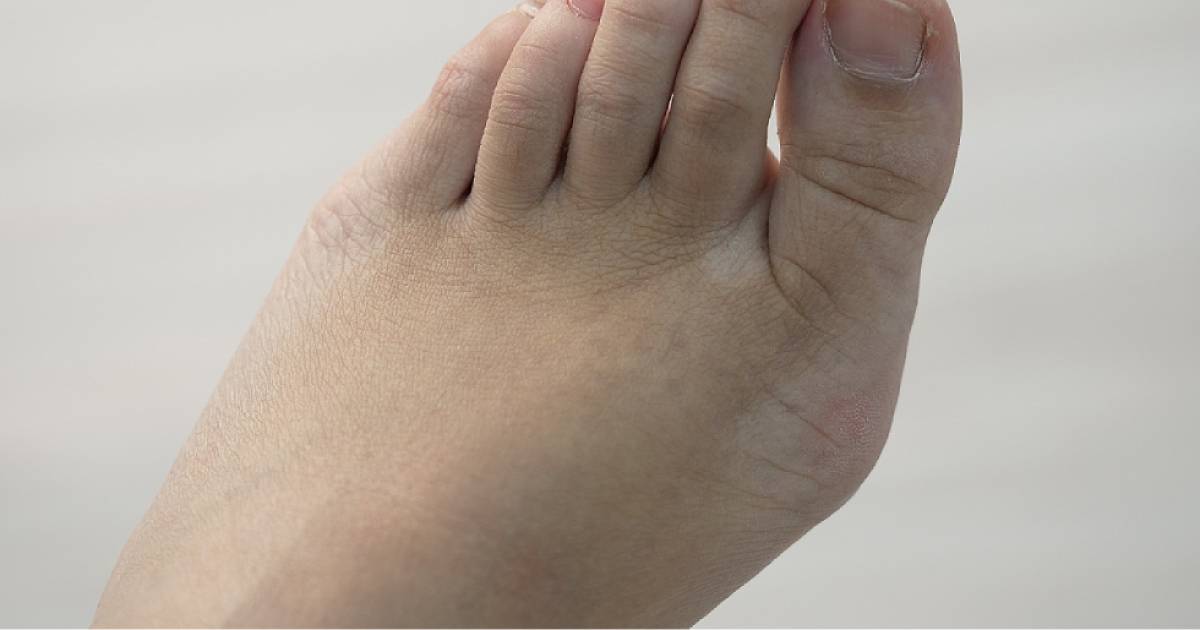 Bunions found in a teenage patient of East Coast Podiatry