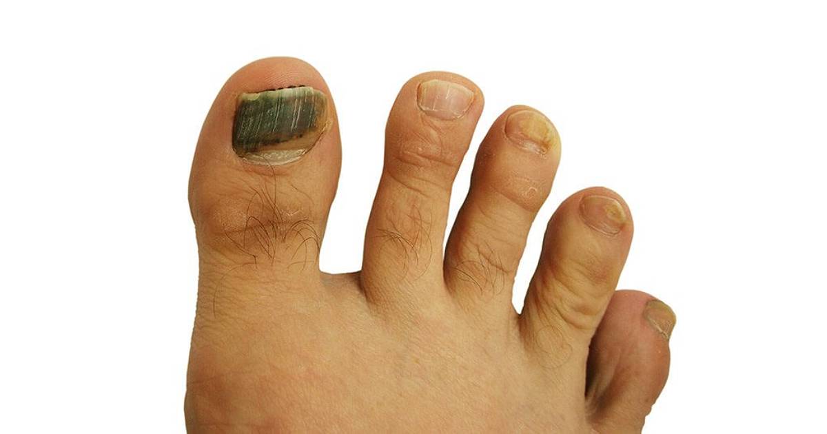 Nail Trauma | Big Toe