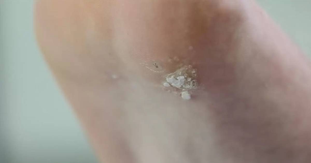 Plantar Warts