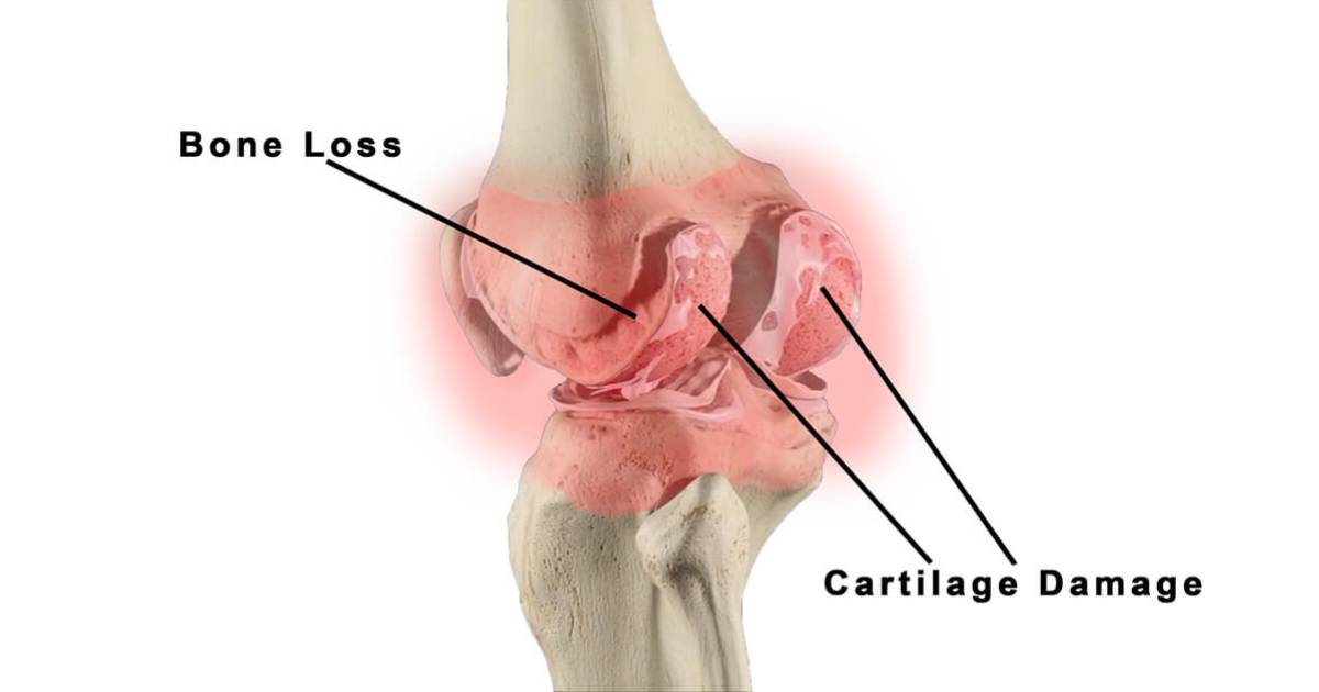 Rheumatoid Arthritis