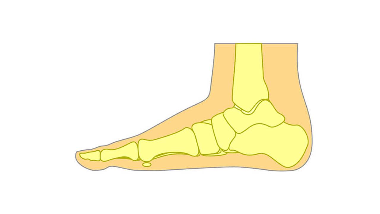 Flat Foot
