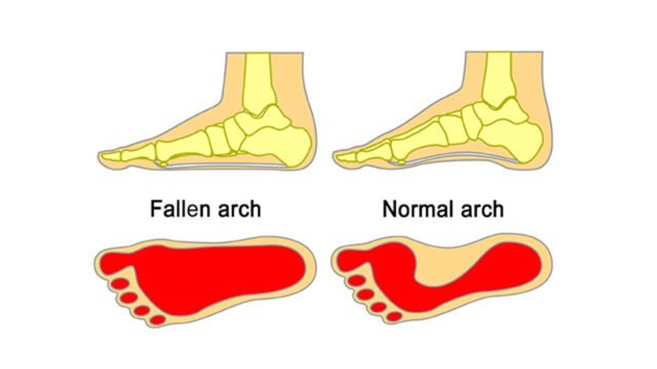 Flat Foot