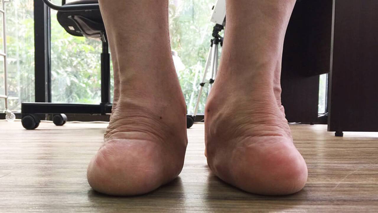 Kinds Of Flat Feet