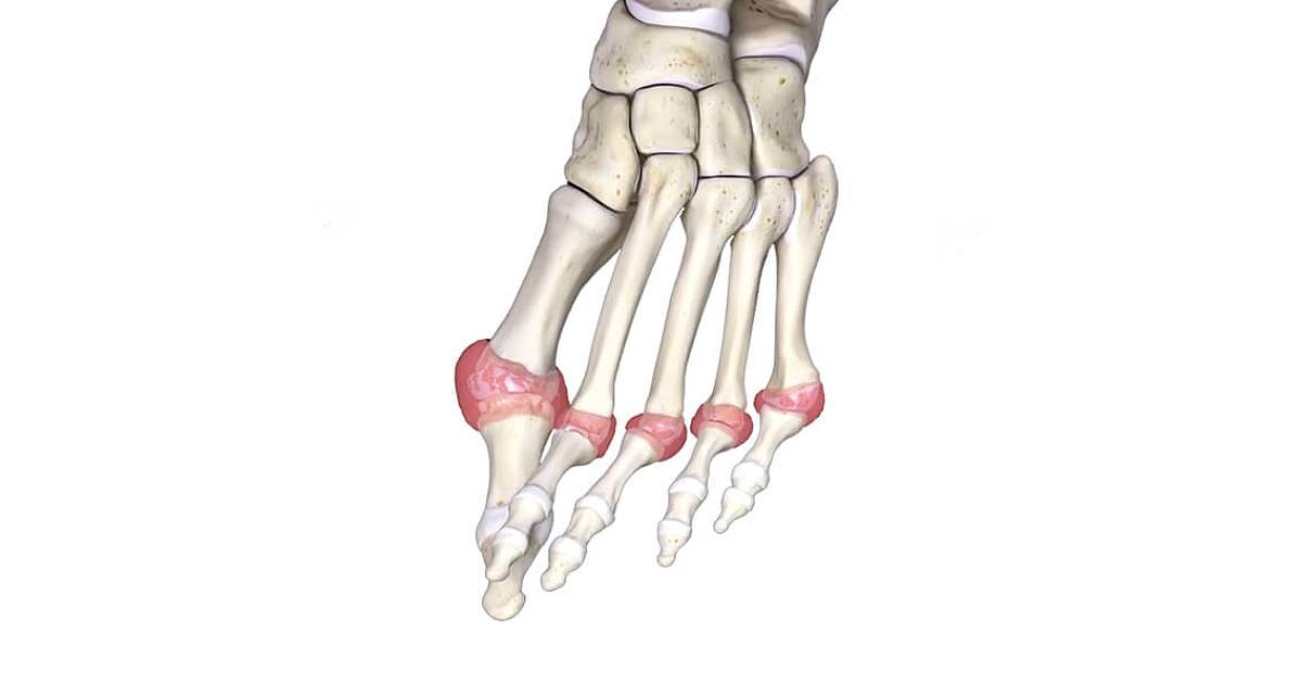Arthritis of the Foot and Ankle
