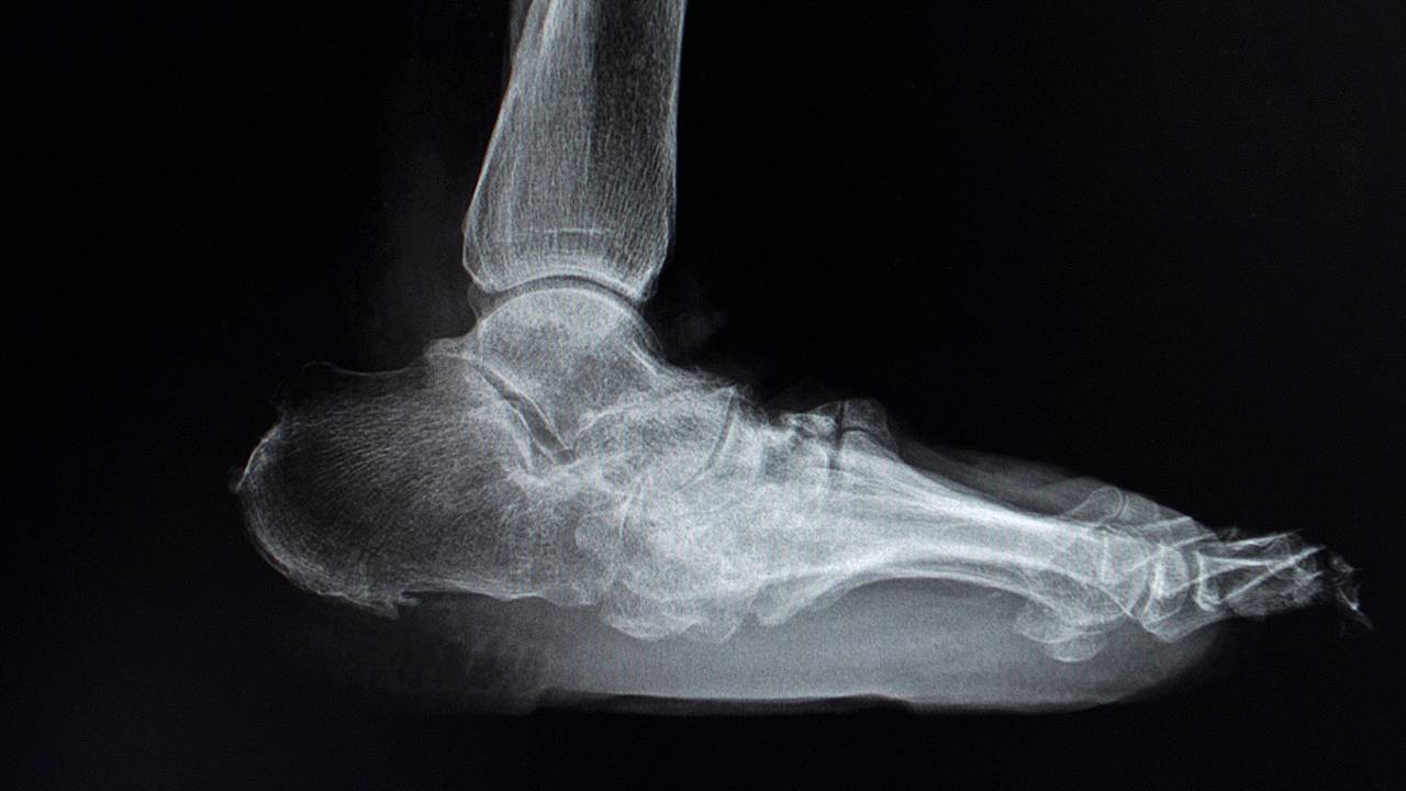 X-ray of Severe Charcot Foot