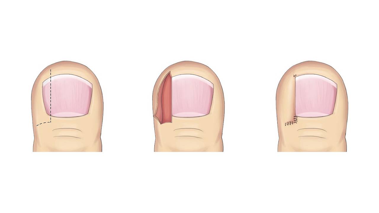 Winograd Procedure