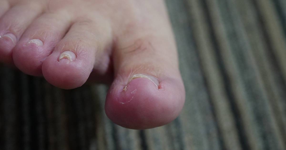 Ingrown toenails