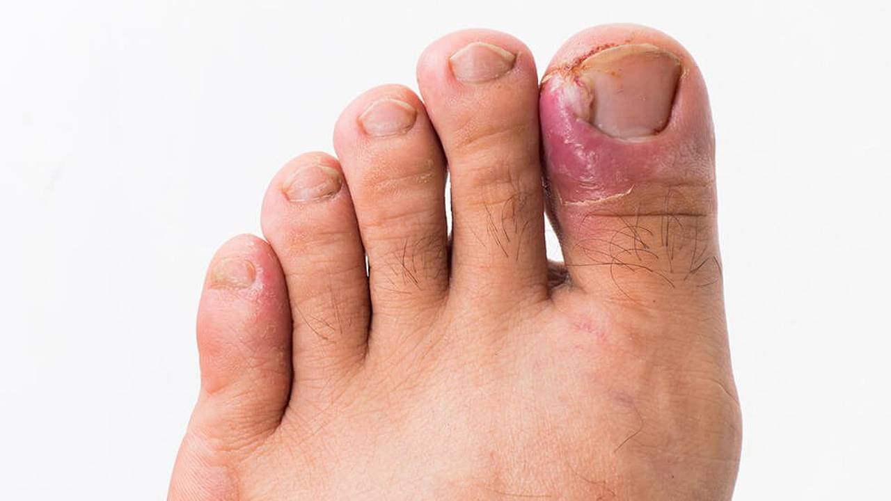 ECPC | Ingrown Toe Nail