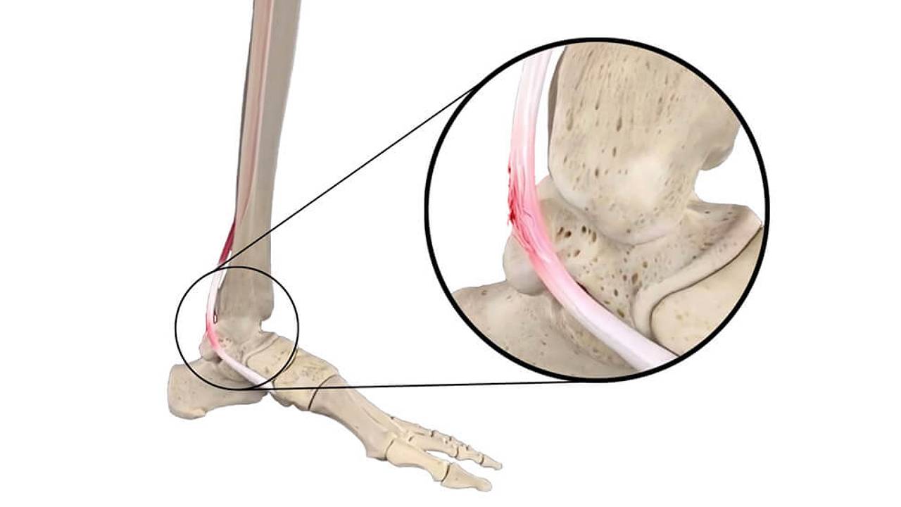 PTTD Posterior Tibial Tendon Dysfunction Skeleton Feet