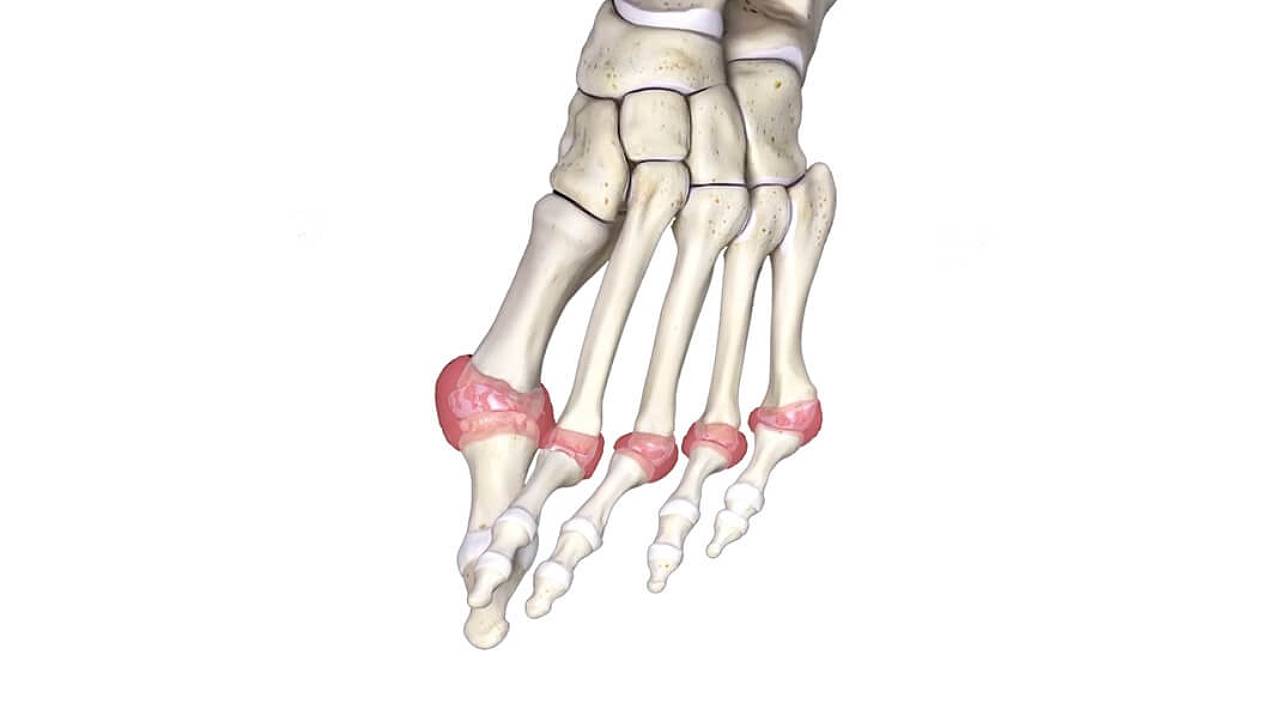 East Coast Podiatry | Skeleton Model of Rheumatoid Arthritis