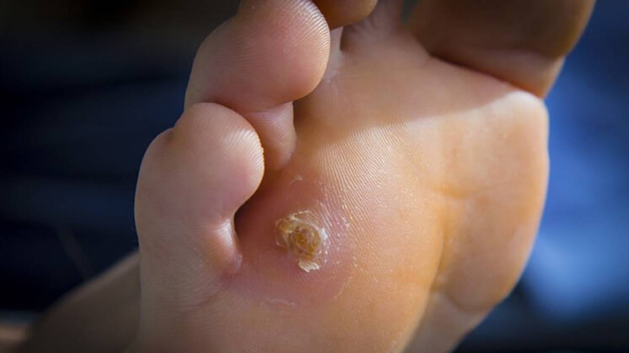 East Coast Podiatry | Plantar Wart