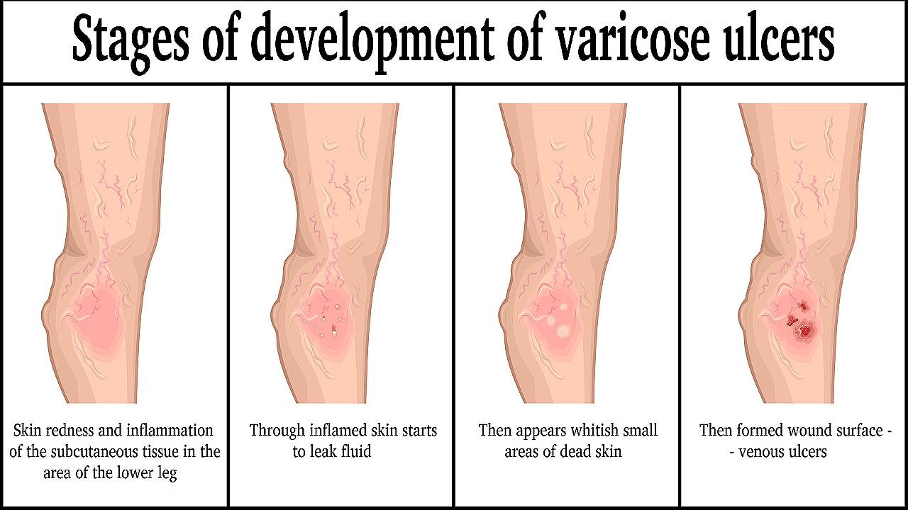 Varicose Ulcers