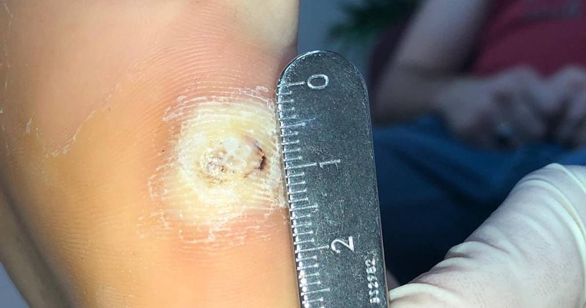 Wart on foot being measured