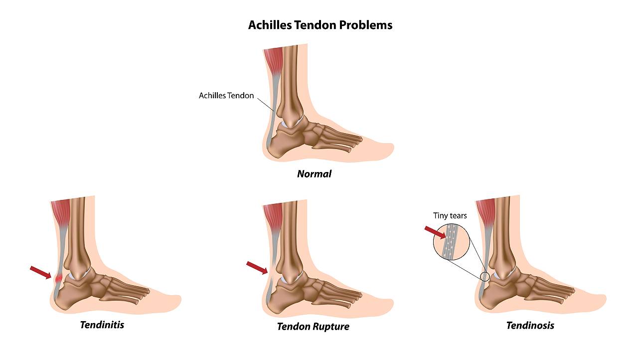 Achilles Tendon Problems