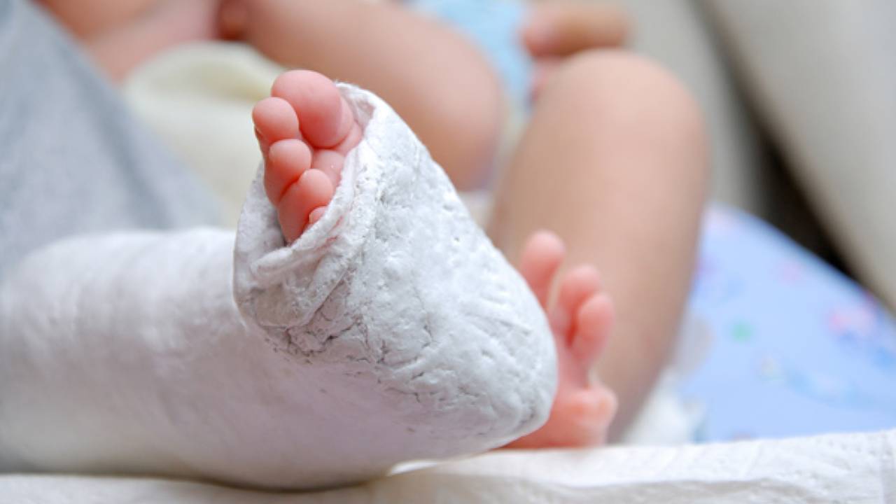 Club Foot Child Casting