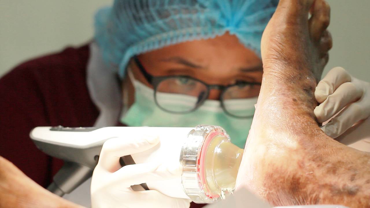 Defocused shockwave | East Coast Podiatry
