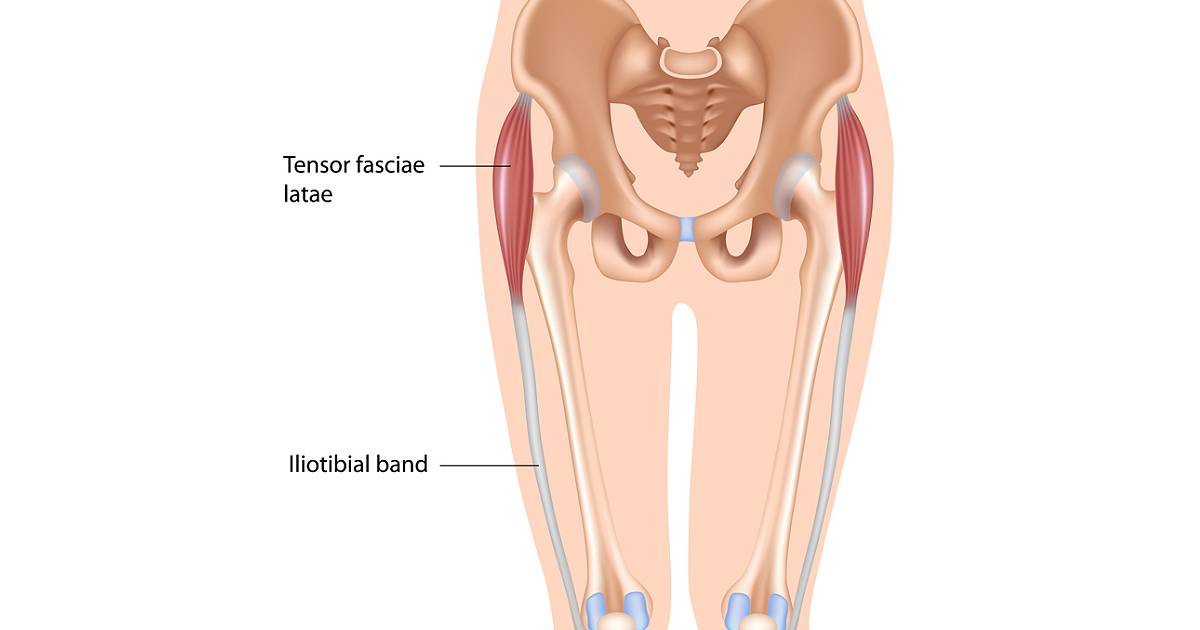 Iliotibial Band Syndrome