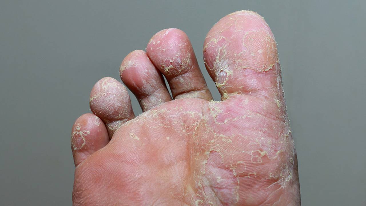 ECPC | Foot Rot