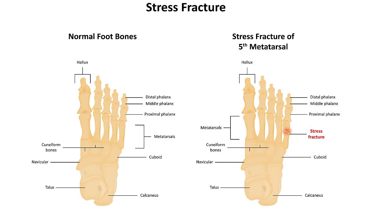 Fractures Metatarsals