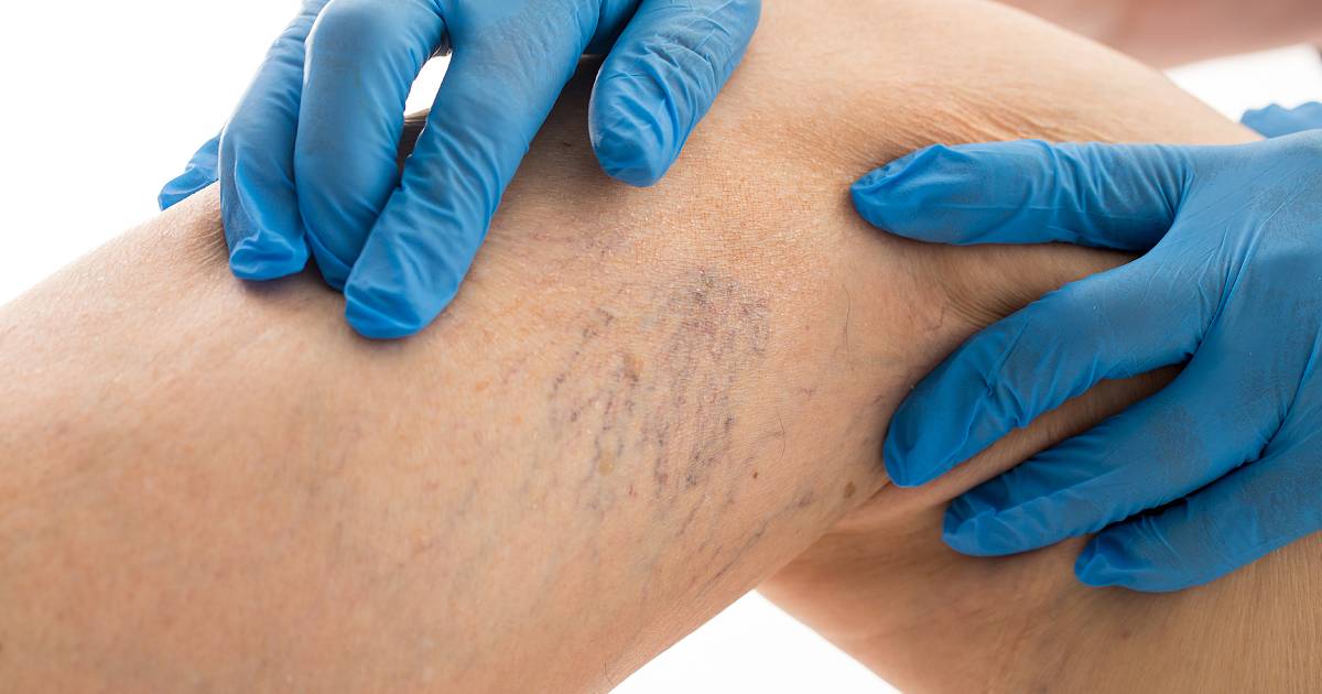 Diabetic Foot Ulcer