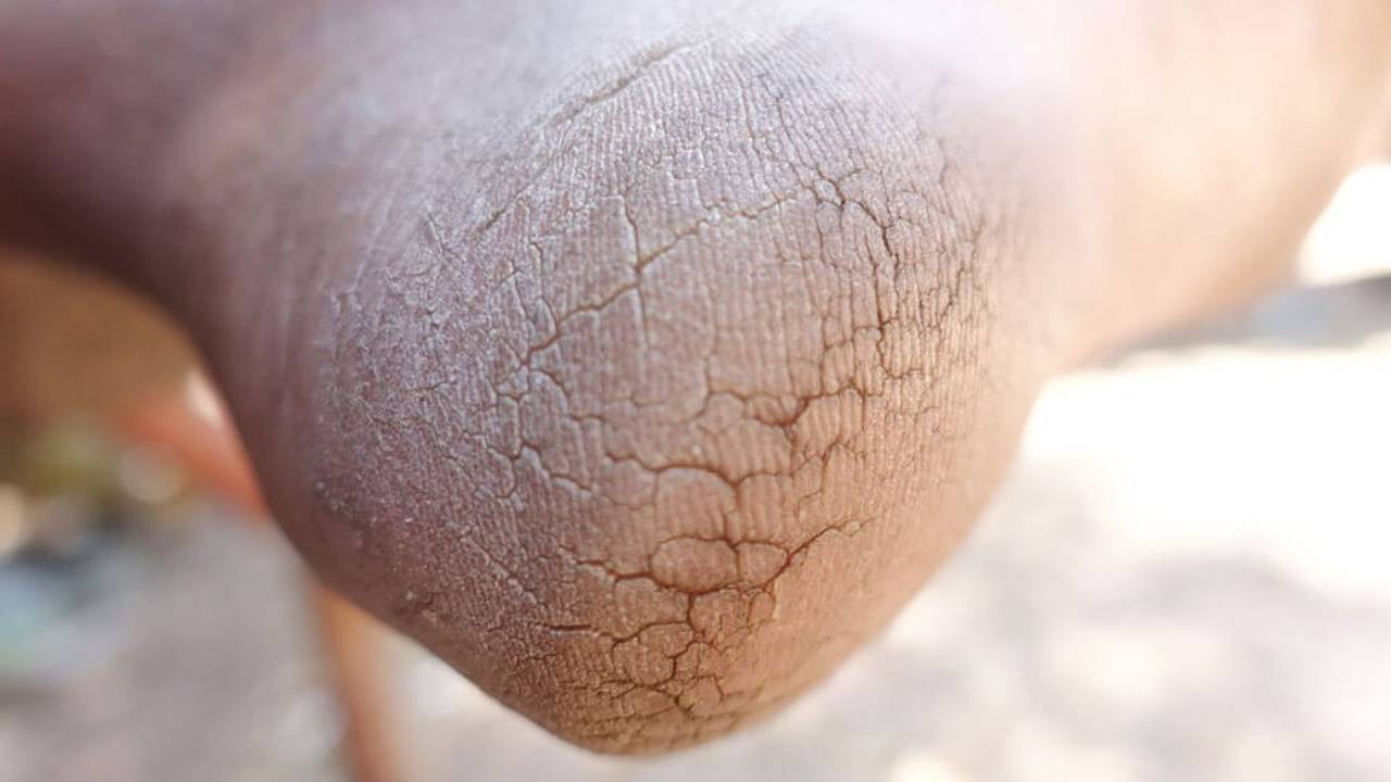 ECP | Cracked Heels