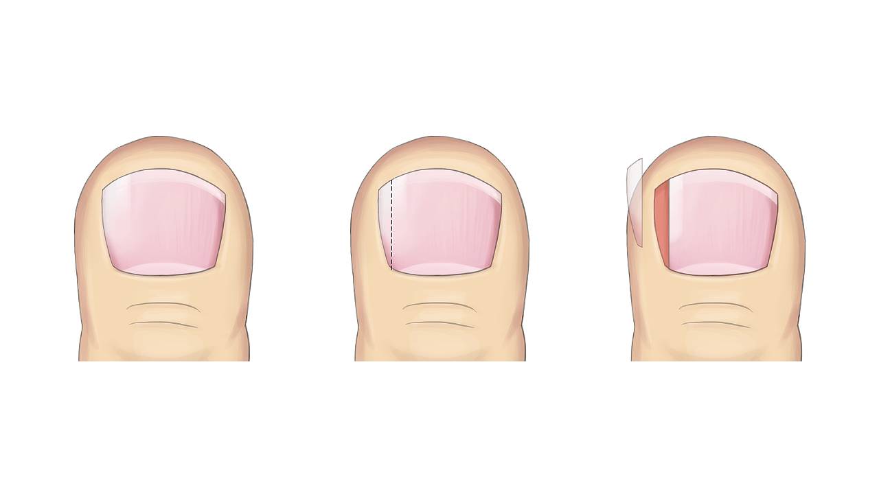 Partial Nail Avulsion