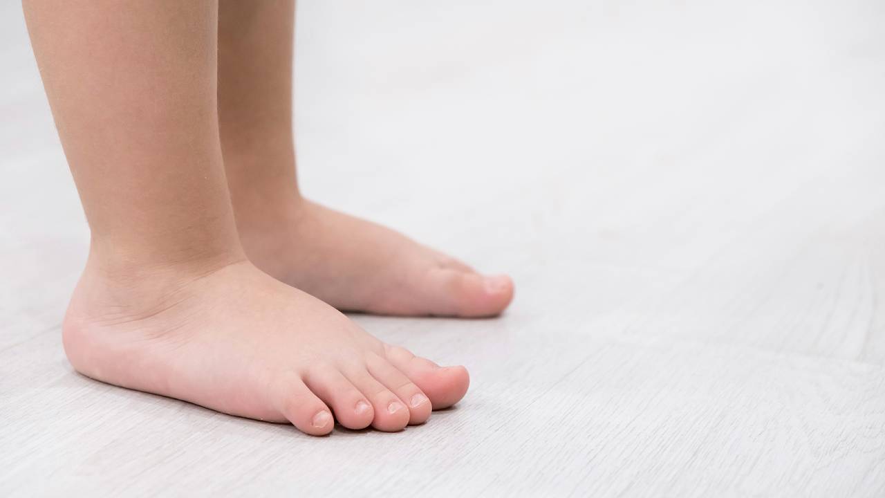 Flat Feet in Children