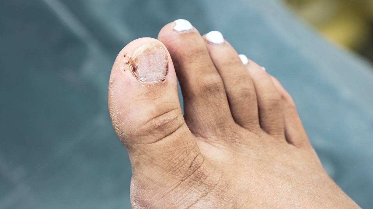 Fungal Infection