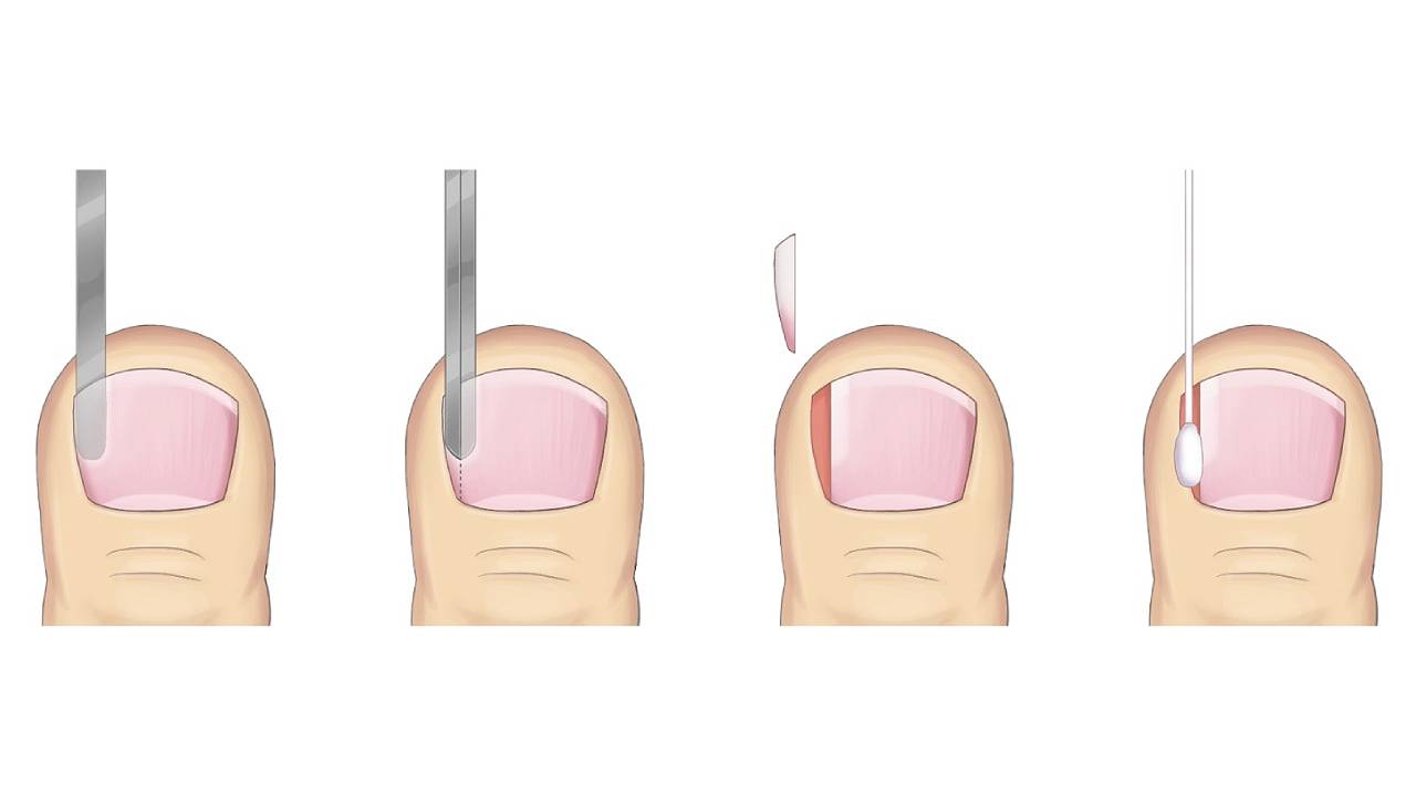 Ingrown Toenail Treatment