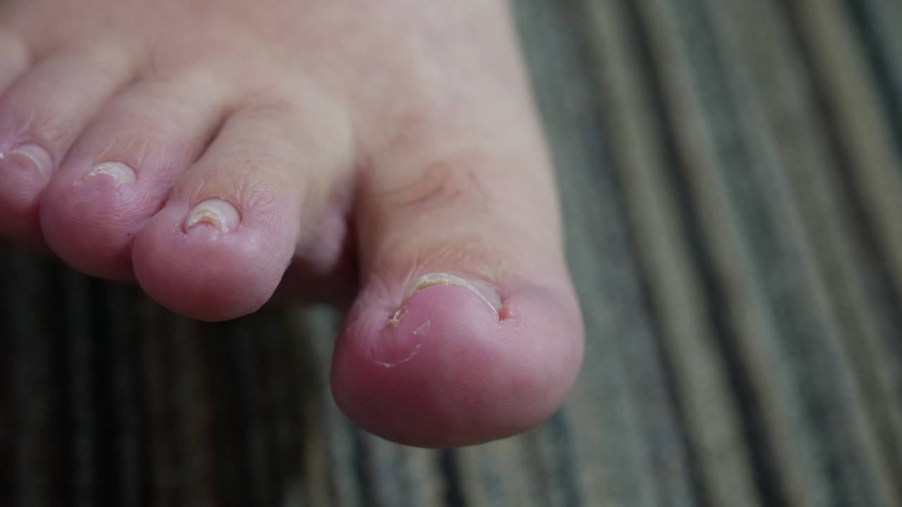 Ingrown Toenail