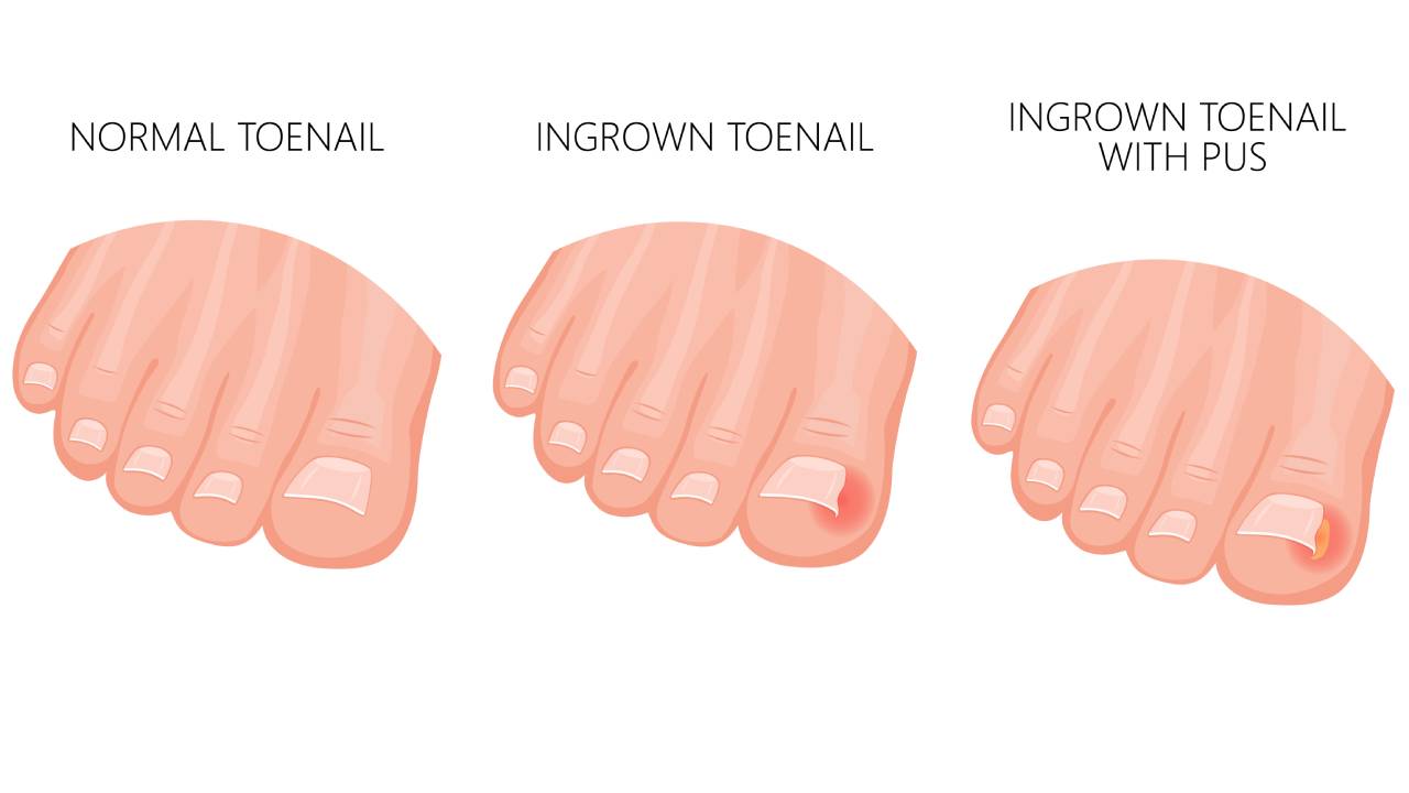 Signs of Ingrown Nail