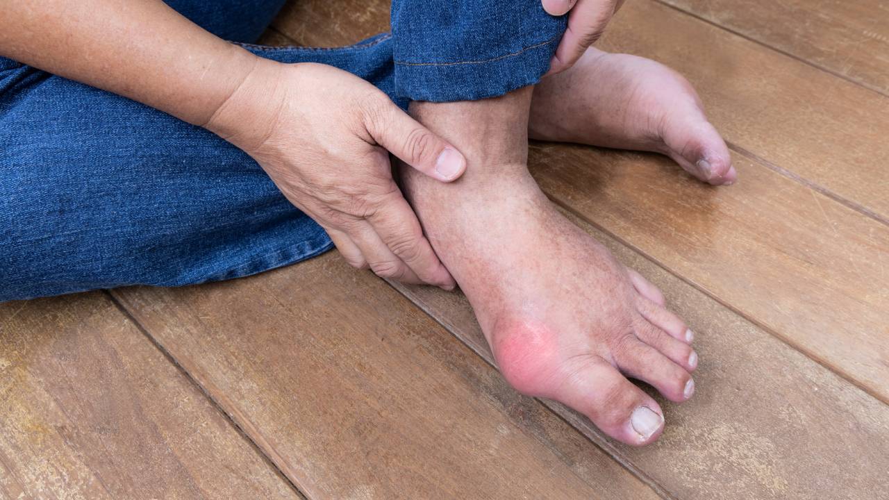 Get Pain Relief from Gout Attacks