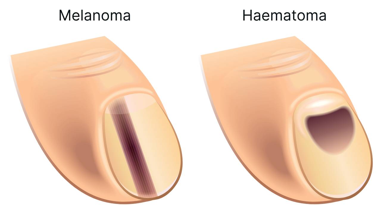 Subungual Melanoma VS Subungual Haematoma