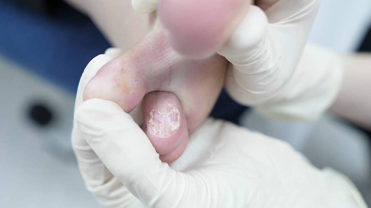 Athlete's Foot Symptoms