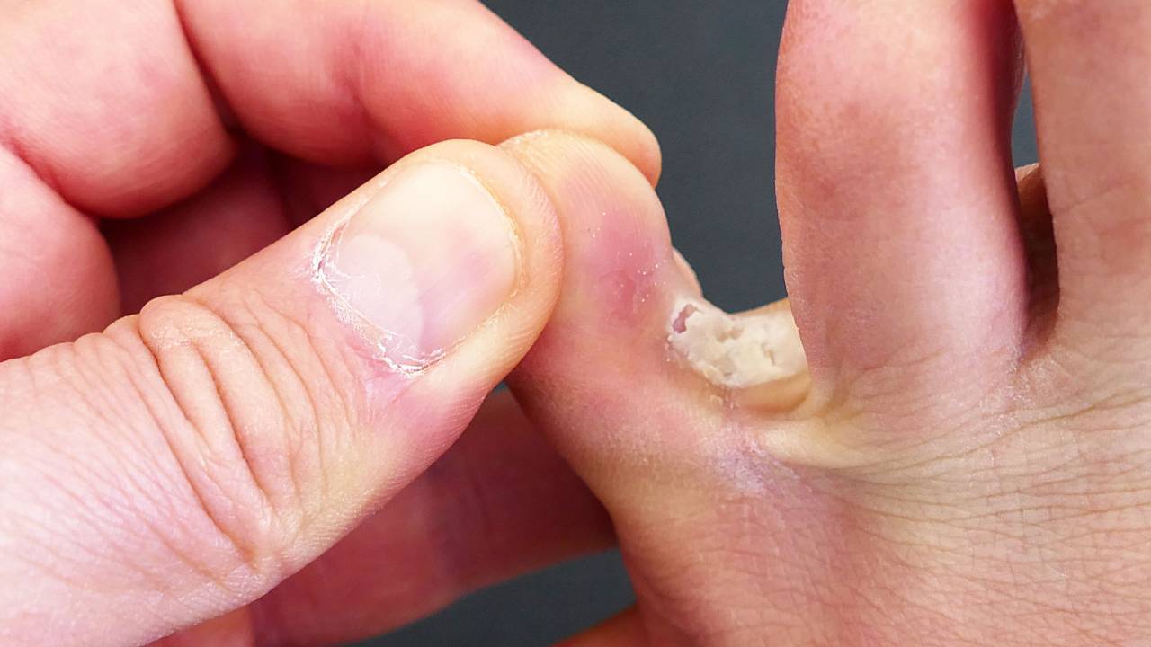Athlete's Foot
