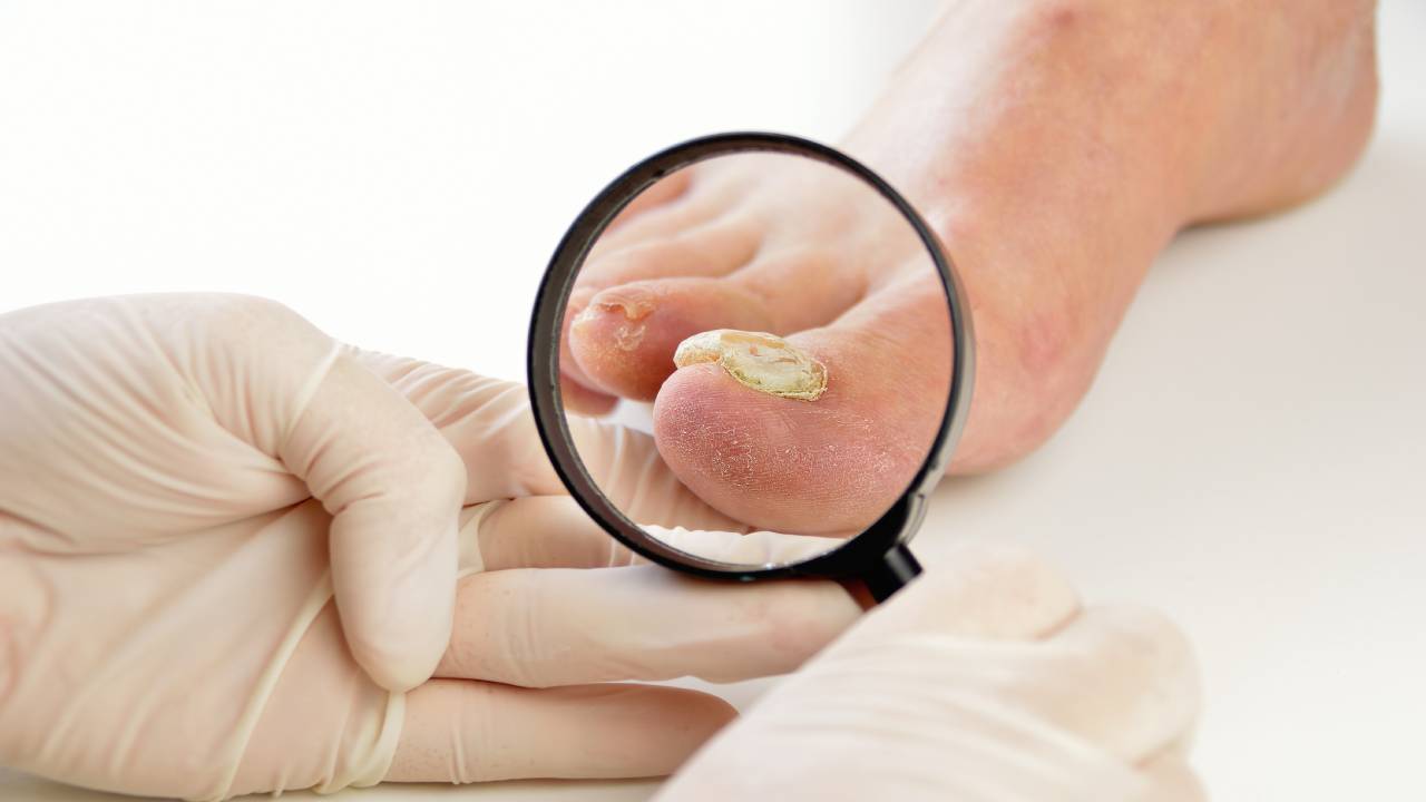 Fungal Nail Infection