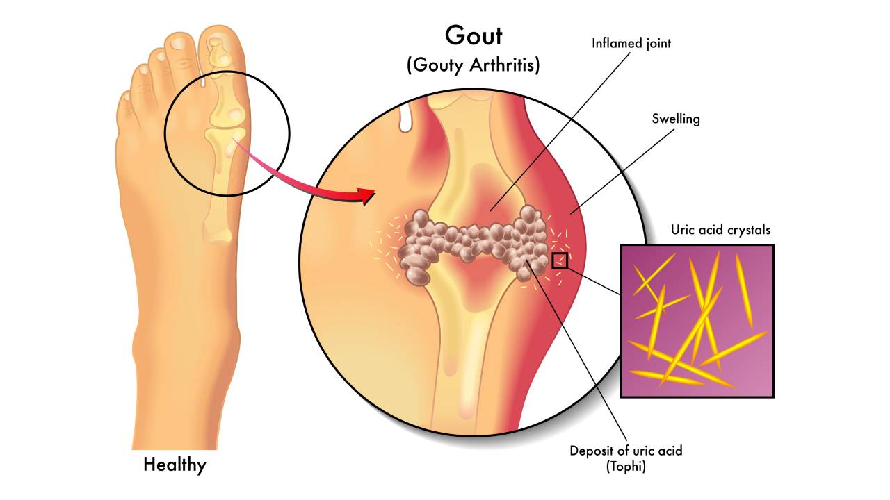 Gout Uric Acid Crystals