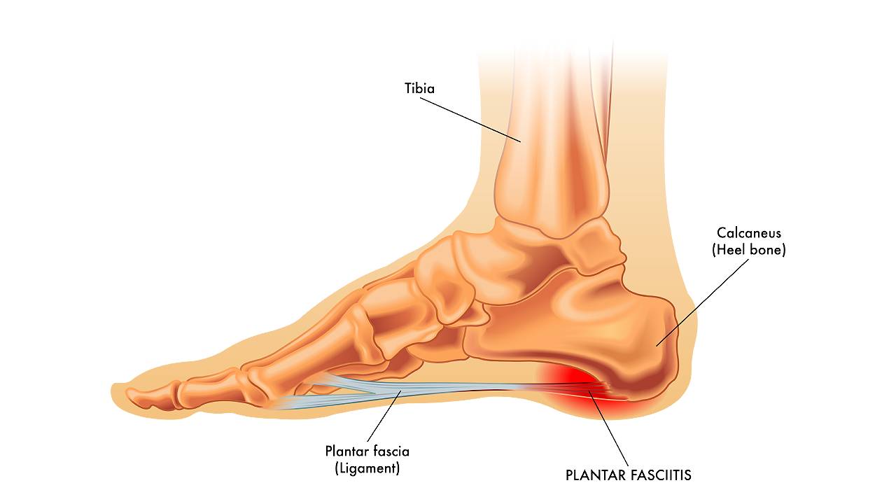 Heel Pain Causes