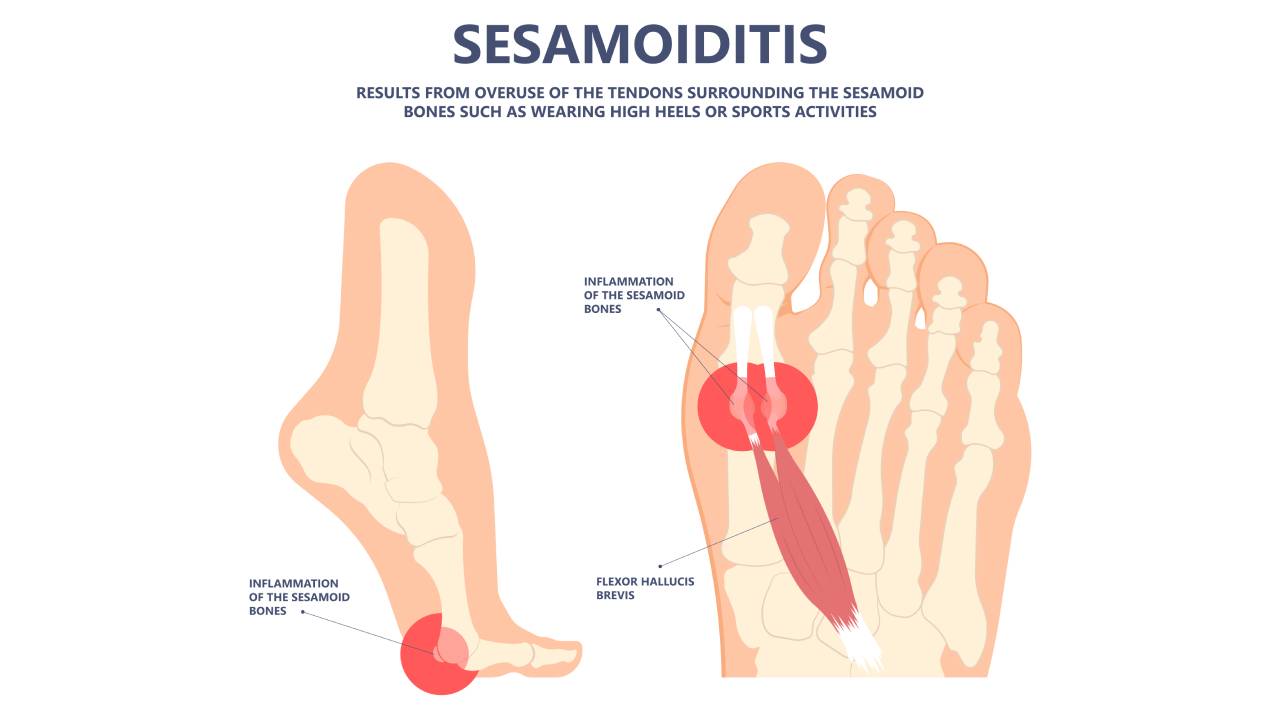 Sesamoiditis