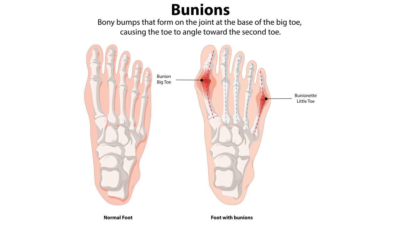 Bunion Symptoms