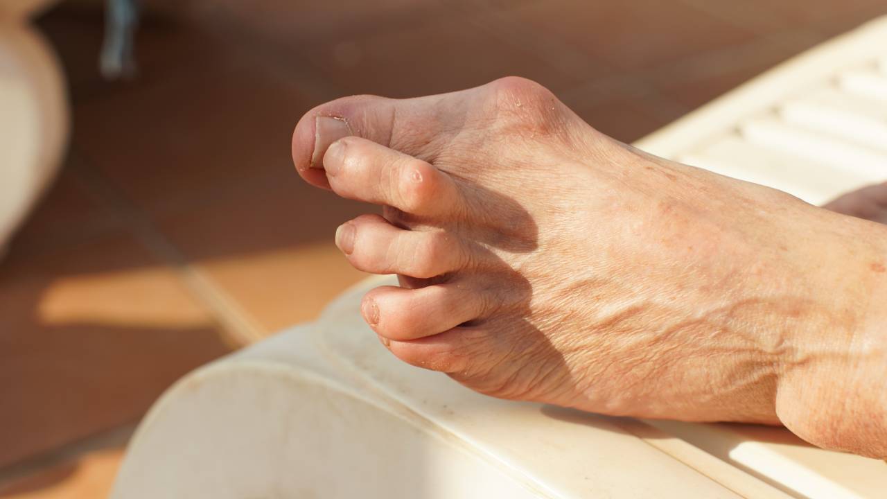 Bunion