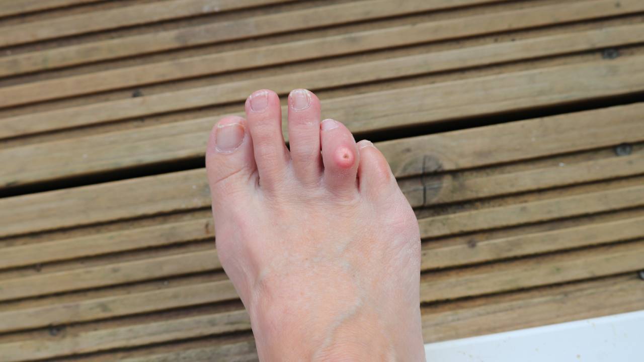 Corn On Foot