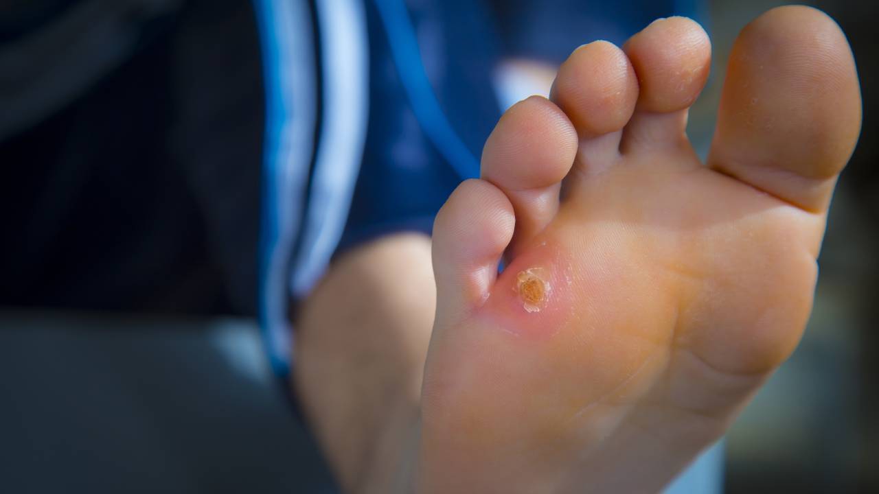 Foot Corn Causes