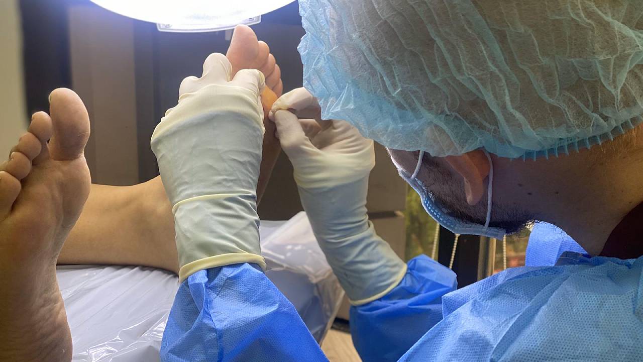 Plantar Wart Removal