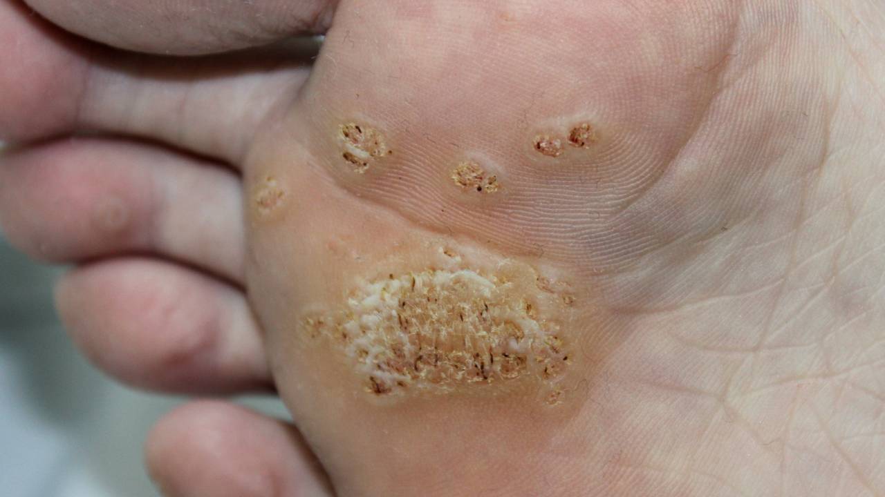 Pantar Wart