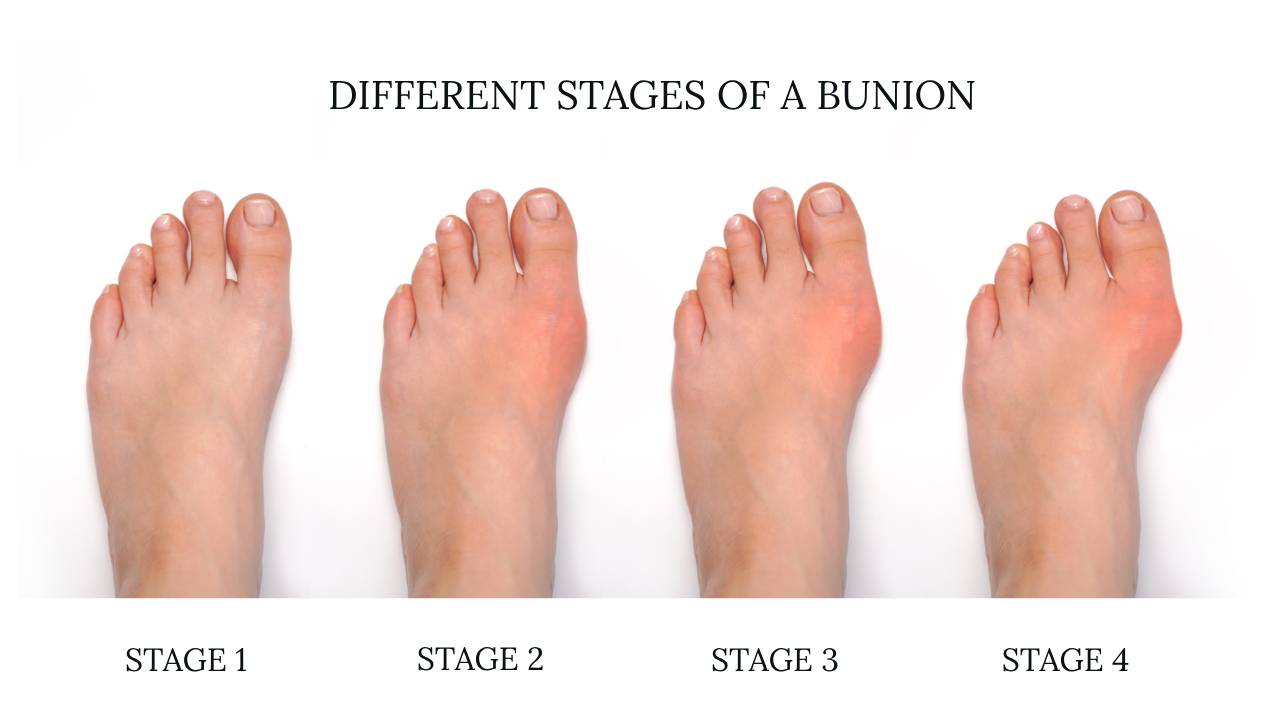 Toe Bunion